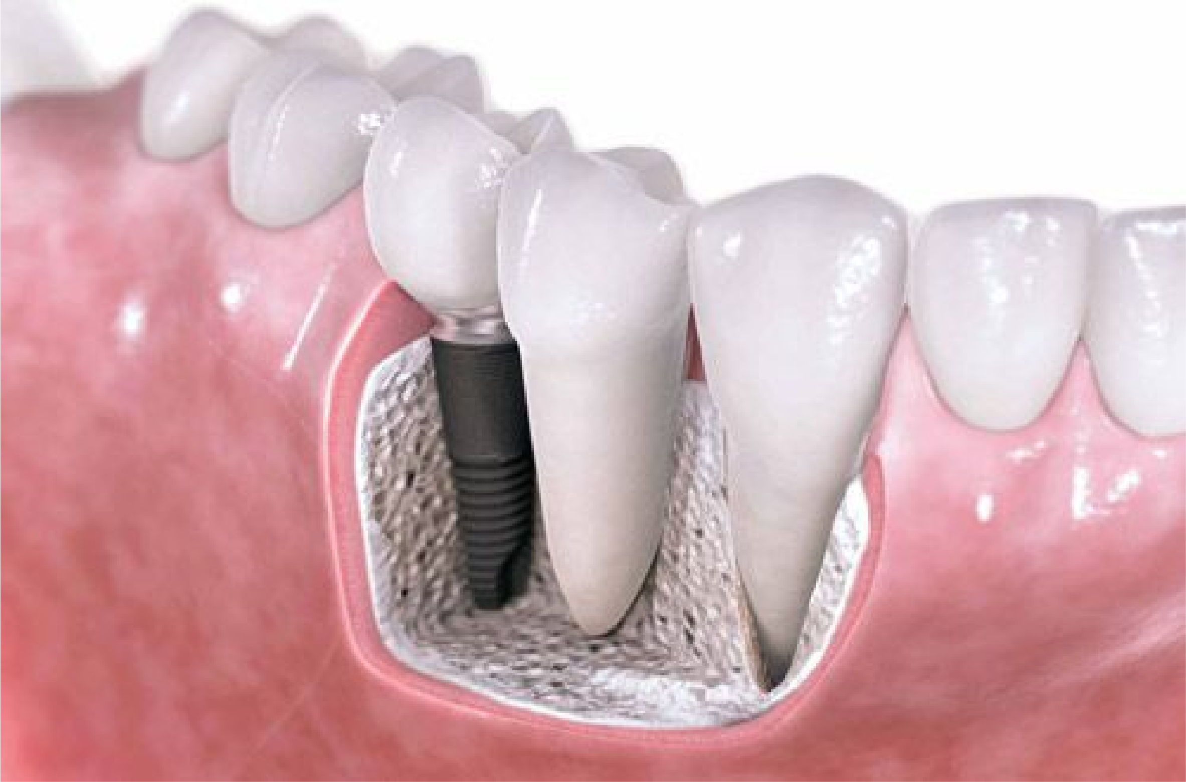 Trồng răng Implant & phục hình tức thì