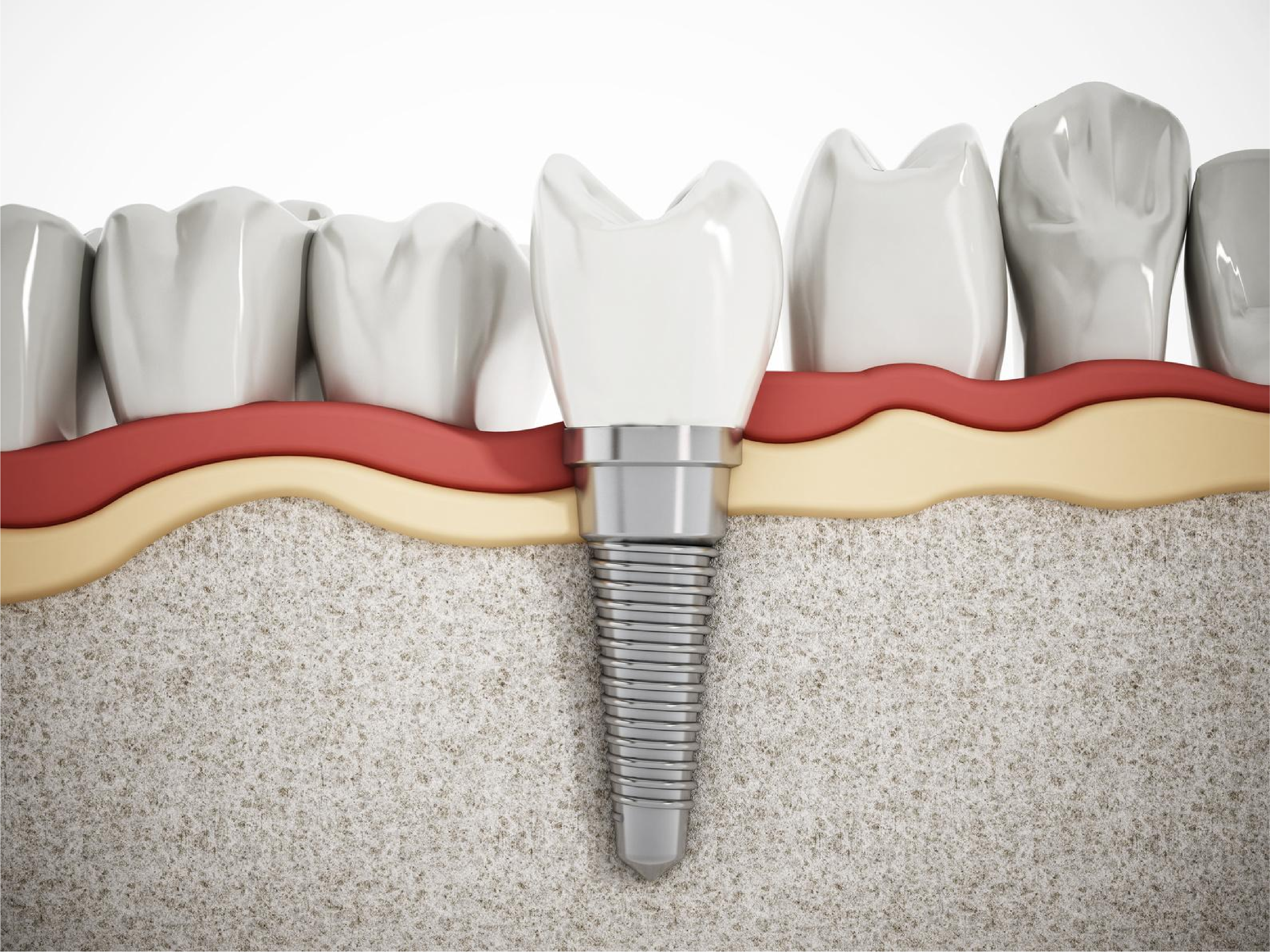 Trồng răng implant thay thế 1 răng