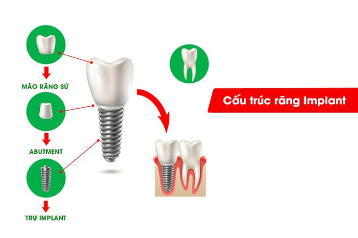 cau-tao-tru-implant