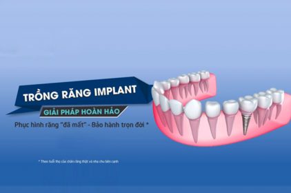 Trồng răng implant – Cấy ghép implant trả góp 0% lãi suất