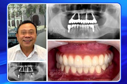 Case: Trồng răng implant toàn hàm All On 4 hàm trên