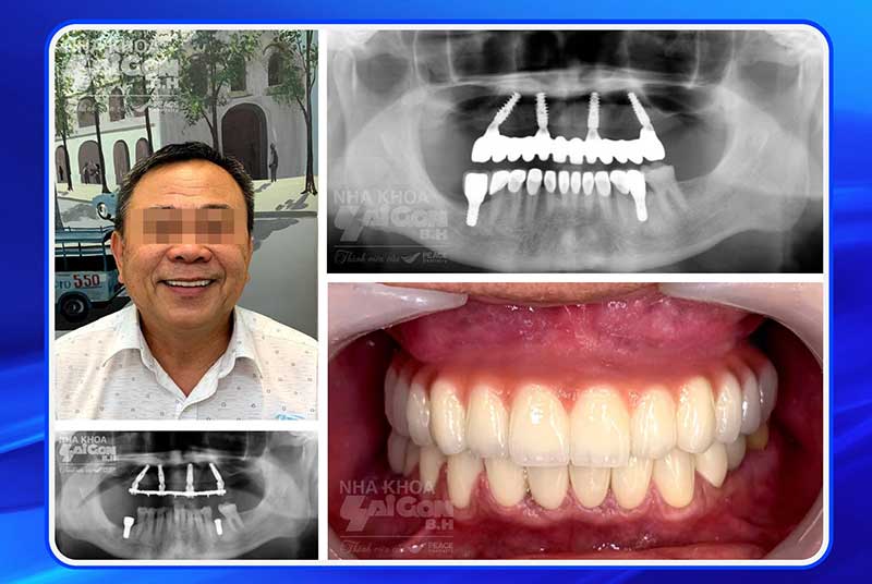 case-implant